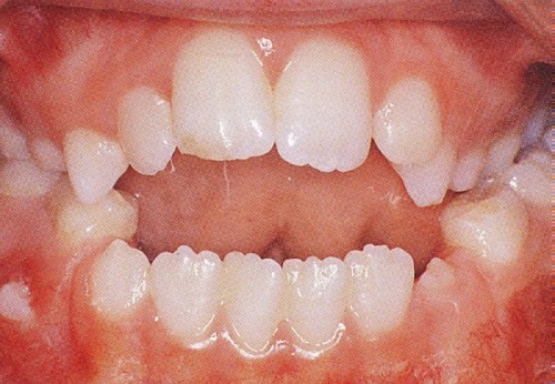 Bệnh Khớp Cắn Hở