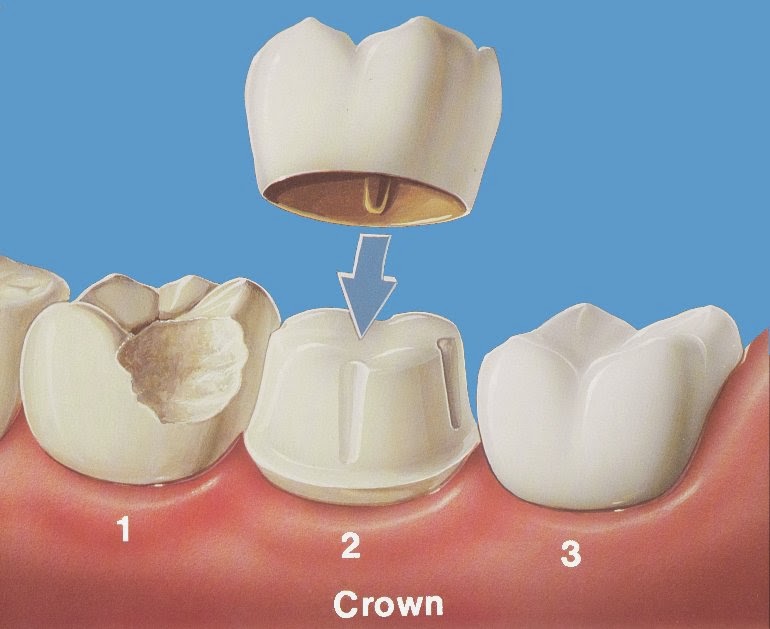 Làm Răng sứ không đau, an toàn, không biến chứng
