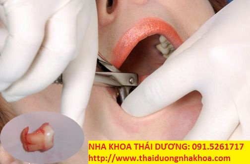 Nhổ Răng Khôn bao nhiêu tiền