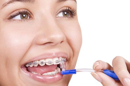 Niềng Răng mắc cài kim loại rẻ nhất, nhanh nhất đạt kết quả đẹp