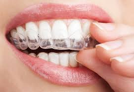 Niềng răng không mắc cài
