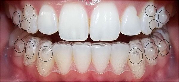 Niềng Răng Không Cần Nhổ Răng