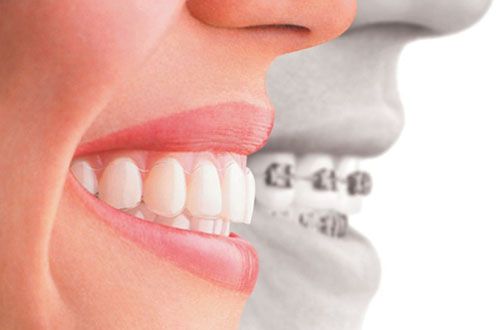 Bác Sĩ Niềng Răng Giỏi ở TPHCM Sài Gòn phải tư vấn đủ các Phương Pháp niềng răng từ RẺ đến Mắc tiền