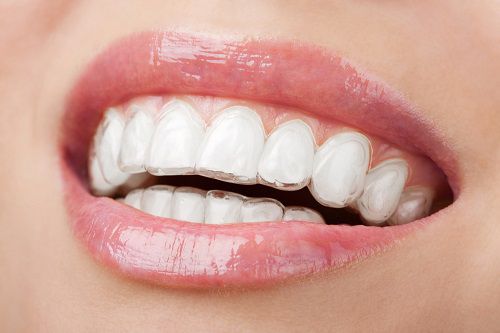 Niềng răng không mắc cài Invisalign Giá bao nhiêu Tiền