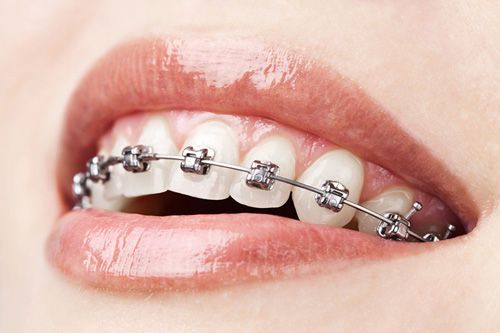 Niềng Răng mắc cài kim loại hiệu quả nhất, nhanh nhất, rẻ nhất