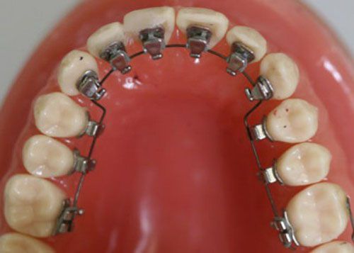 Niềng Răng Mặt Trong Cách Niềng răng bí mật