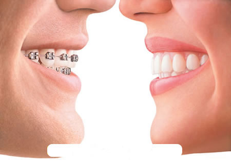 Niềng Răng Trả góp Không Lãi Suất ở TPHCM