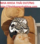 Phục Hình Trồng răng Giả Cố định dùng Mão Kim loại Thường NiCr