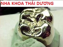 Phục Hình Trồng răng Giả Cố định dùng Mão Kim loại Quý Kim (Vàng + Bạch Kim)