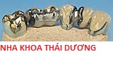 Phục Hình răng giả cố định khung kim loại, phủ nhựa bên ngoài