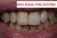 Phục hình răng giả cố định là gì- sử dụng mão răng giả bằng nhựa