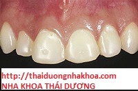 Phục hình răng giả cố định là gì - Trám răng thẩm mỹ composite mặt răng