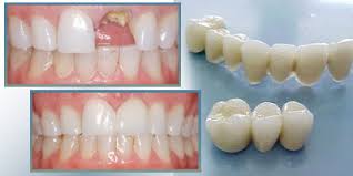 Bọc mão răng sứ Cercon