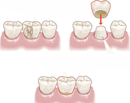Răng Thưa phải làm sao và cách khắc phục hiệu quả đẹp thẩm mỹ nhất, nhanh nhất, Giá trung bình bằng Bọc Mão sứ