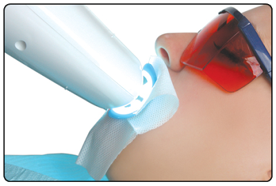 Tẩy trắng răng đèn laser
