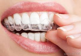 Tẩy Trắng răng máng tẩy tại nhà