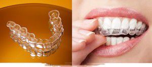 Tẩy Trắng răng tốt nhất tại TPHCM Saigon