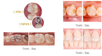 Trám răng thẩm mỹ giá rẻ nhất, đẹp nhất TP HCM