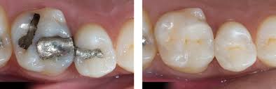 Trám răng thẩm mỹ