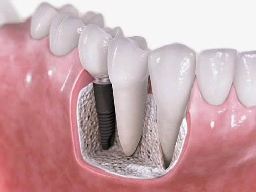 Trồng răng Implant và Bọc răng sứ