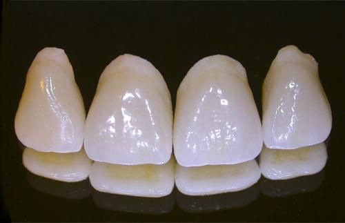Trồng răng sứ sườn kim loại Titan
