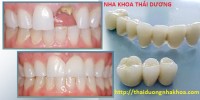 Bọc Răng sứ Thẩm Mỹ Uy Tín, Đep, Chất Lượng tốt ở đâu TPHCM