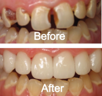 Làm Răng Sứ Thẩm mỹ đau không?
