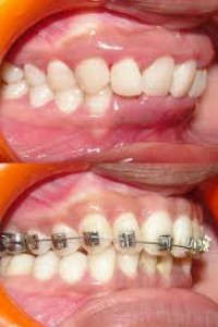 Niềng răng hô, niềng răng móm giá bao nhiêu